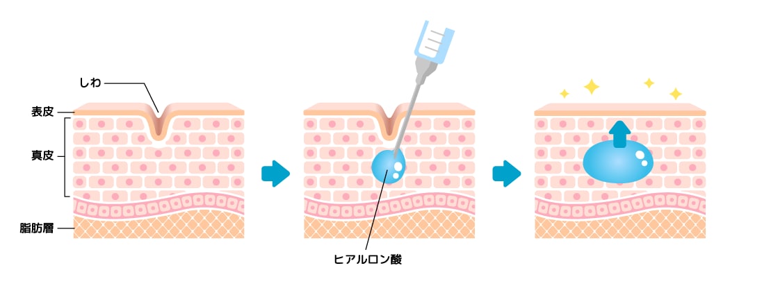 もともと体の一部にある組織
